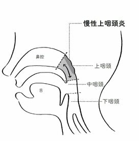不調の原因は「慢性上咽頭炎」かも。習慣に気候、気をつけたい3つのポイント