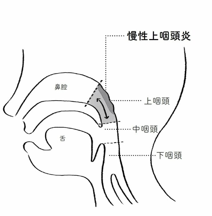 慢性上咽頭炎