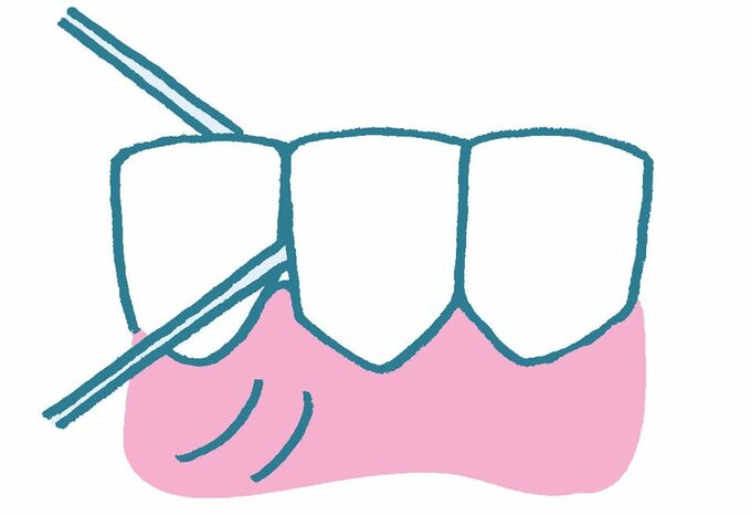 イラスト歯にデンタルフロス