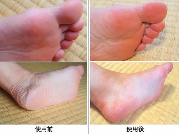 足裏角質ケアパックの使用前後