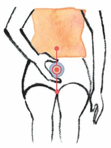 ペットボトルの底面を、下腹の「関元」に押し当て、アチッと思ったら離すのを数回繰り返す