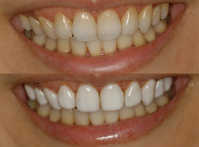 施術前と後の歯