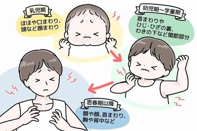 アトピーの図解