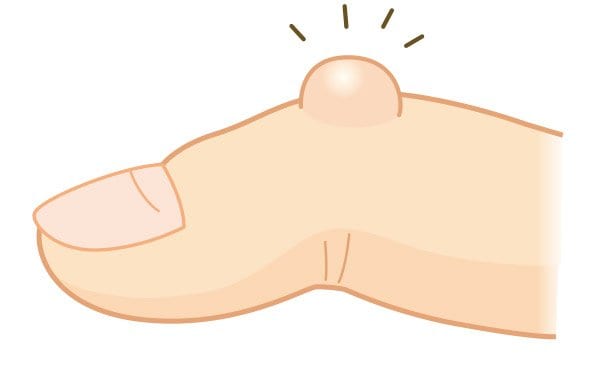 関節にコブ(結節)ができる