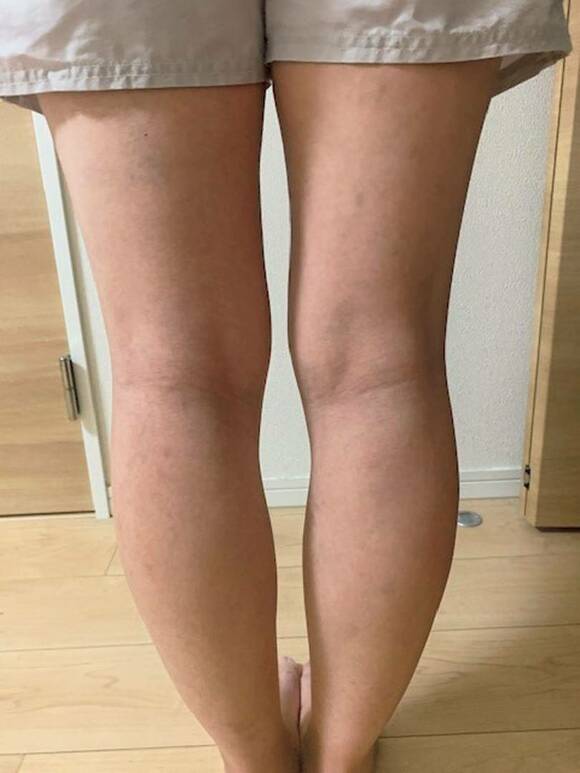 足後ろからBEFORE