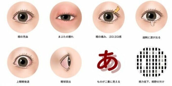 甲状腺眼症（TED）のおもな症状