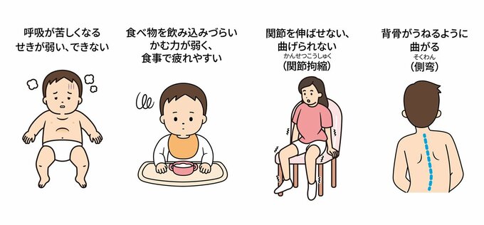 SMAがもとで引き起こされる症状（合併症）