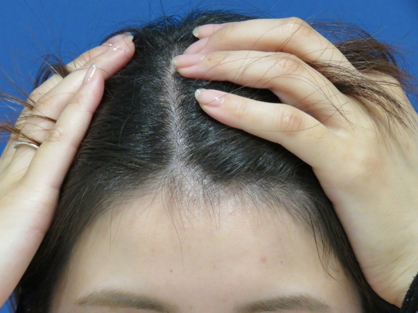 髪がごっそり抜ける「コロナ抜け毛」。20代女性が抱えた不安とその後 | ESSEonline（エッセ オンライン）