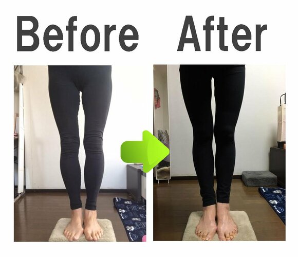 O脚が改善し、両ひざがくっついた！