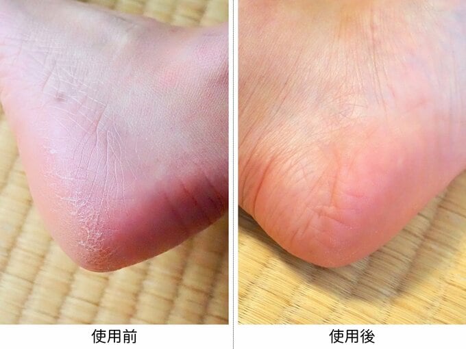 卵みたいにツルピカに!