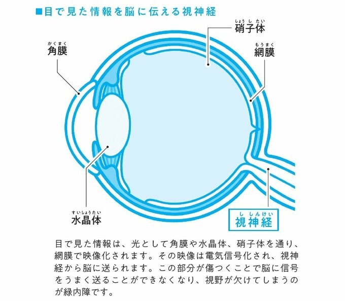 緑内障説明