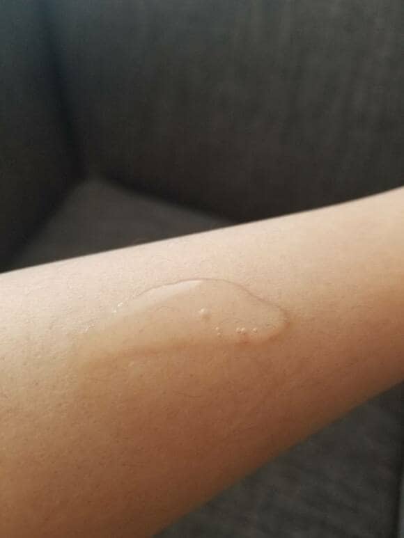 腕にゲル状の透明な液体