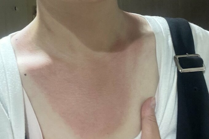 別の取材で日焼けしたときのもの