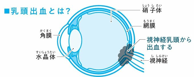 視神経の出口である乳頭部からの出血は、健康な人では極めて稀なケース。緑内障を発症している人、もしくは発症しつつある人に特徴的に生じる出血とされる