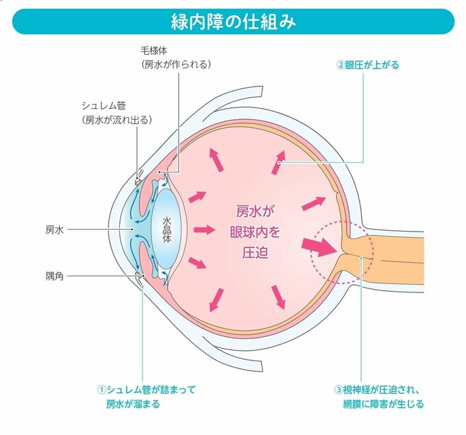 緑内障のしくみ