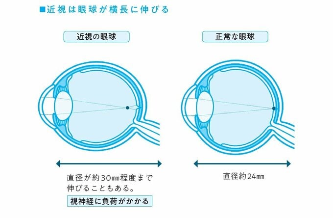 近視の眼球の特徴