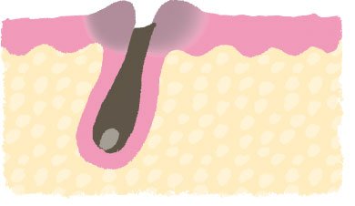 強い力でそると黒ずみの原因に