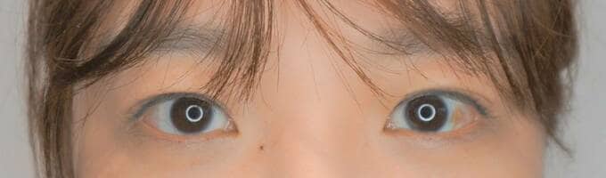 切開ラインアフターアップ